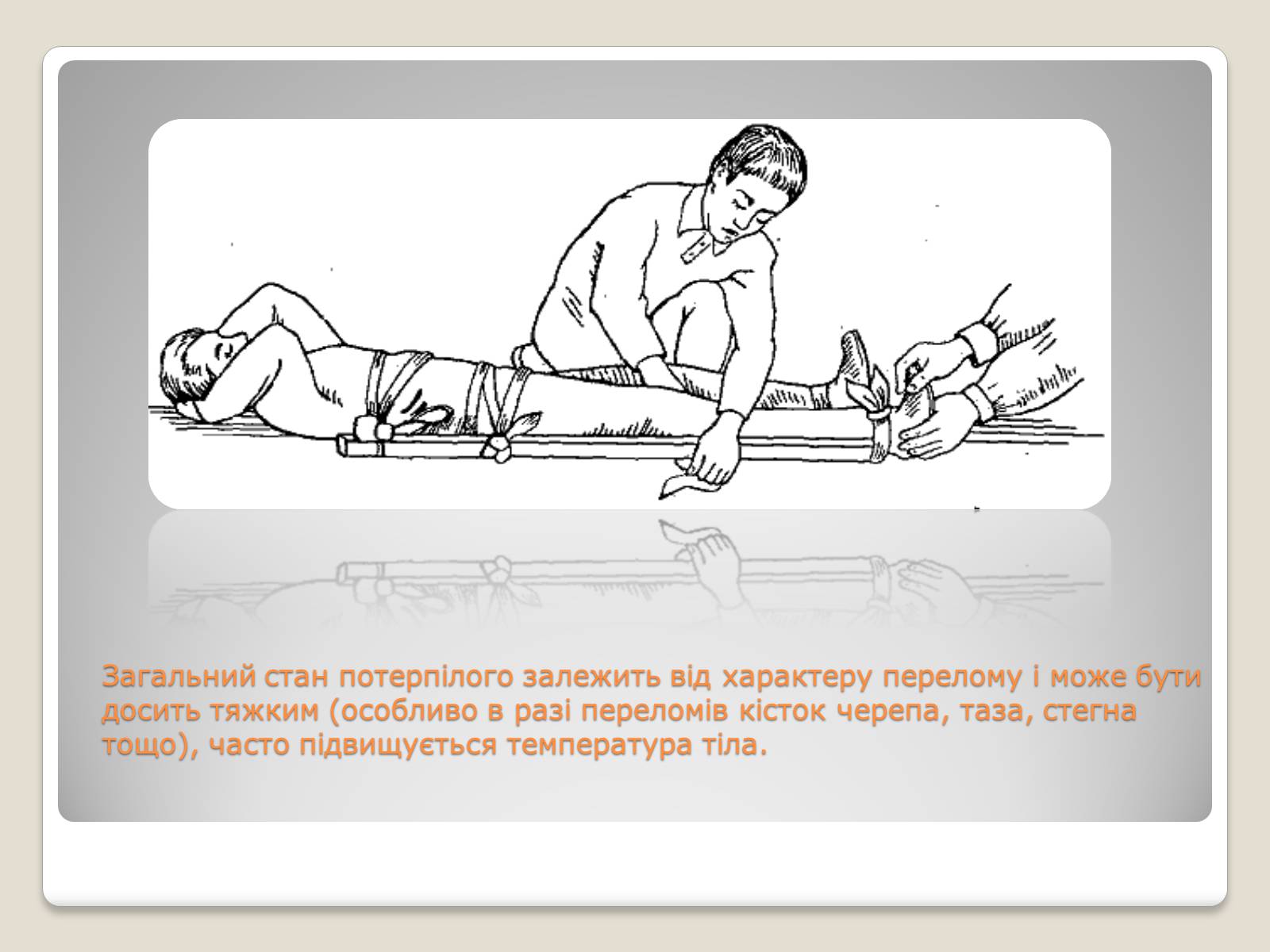 Презентація на тему «Переломи і вивихи» (варіант 3) - Слайд #7 Презентація на тему «Переломи і вивихи» (варіант 3) - Слайд #7