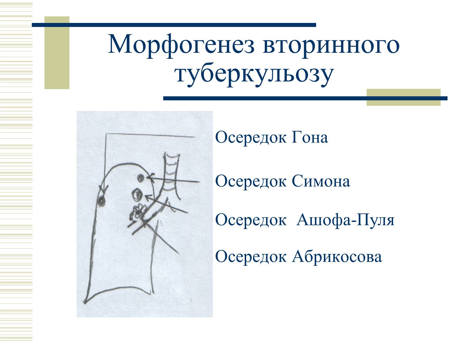 Презентація на тему «Патологічна анатомія туберкульозу» - Слайд #25 Презентація на тему «Патологічна анатомія туберкульозу» - Слайд #25