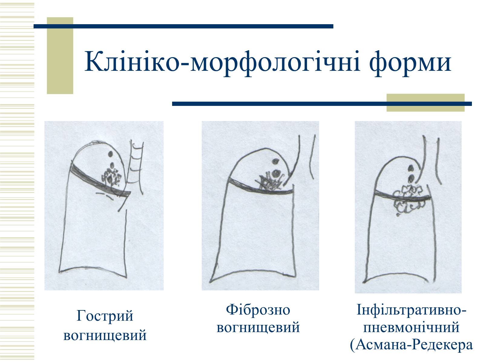 Презентація на тему «Патологічна анатомія туберкульозу» - Слайд #26 Презентація на тему «Патологічна анатомія туберкульозу» - Слайд #26