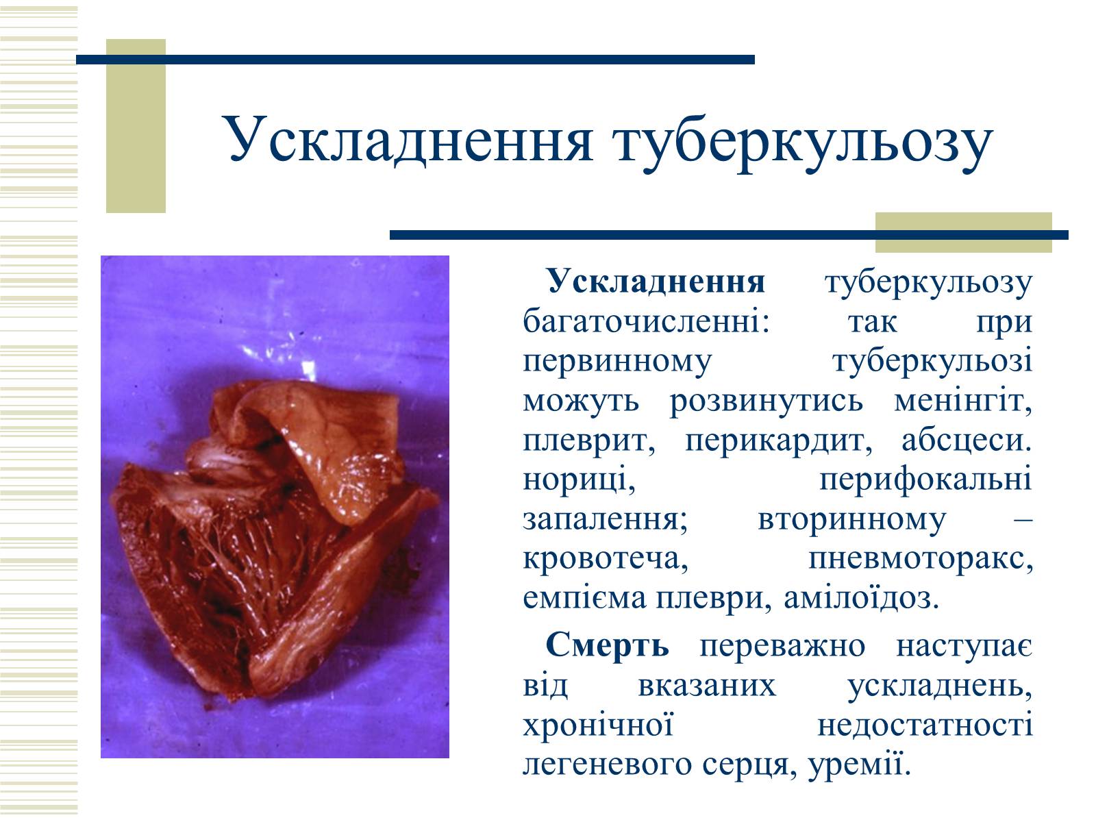 Презентація на тему «Патологічна анатомія туберкульозу» - Слайд #29 Презентація на тему «Патологічна анатомія туберкульозу» - Слайд #29