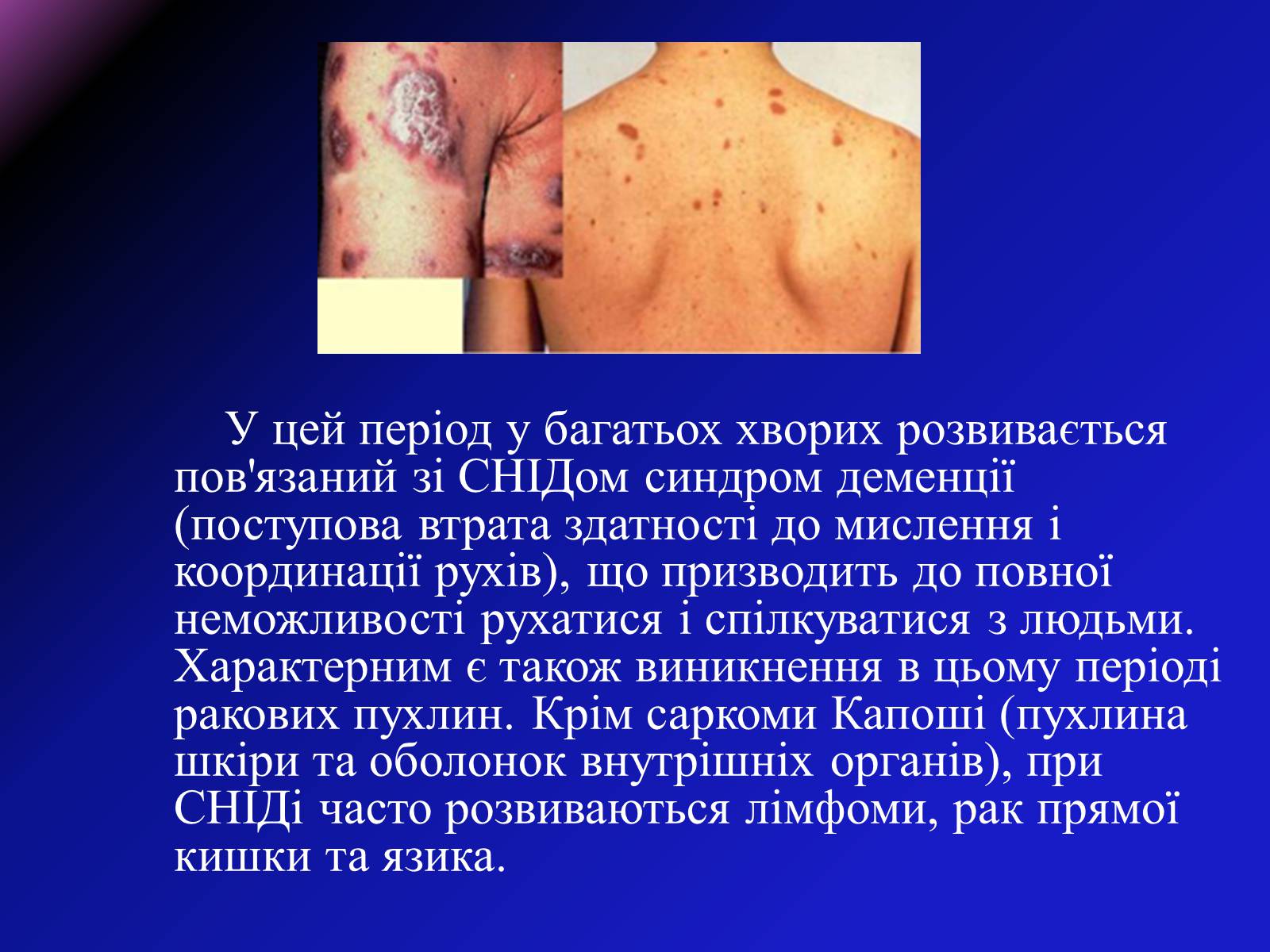 Презентація на тему «СНІД» (варіант 8) - Слайд #14 Презентація на тему «СНІД» (варіант 8) - Слайд #14