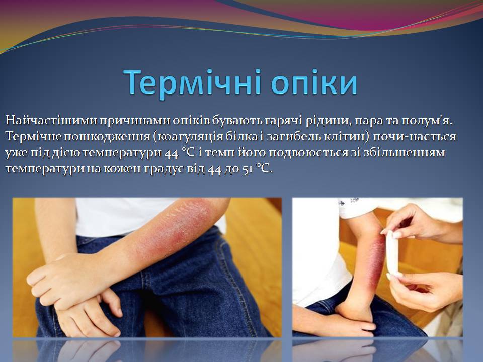 Презентація на тему «Опіки. Перша допомога при опіках» - Слайд #4 Презентація на тему «Опіки. Перша допомога при опіках» - Слайд #4