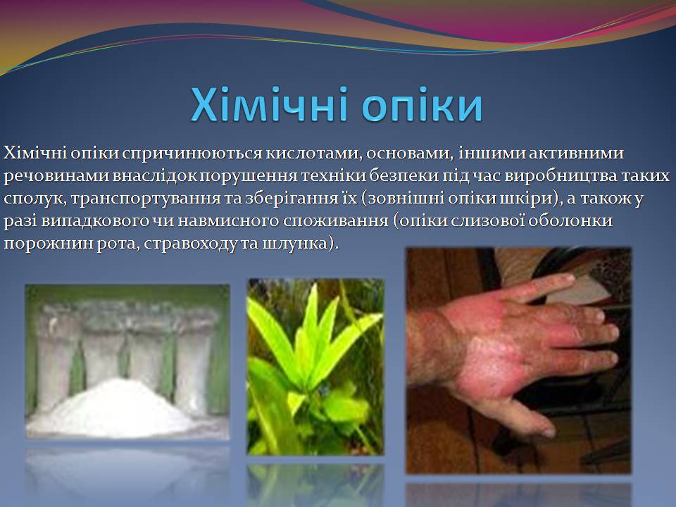 Презентація на тему «Опіки. Перша допомога при опіках» - Слайд #5 Презентація на тему «Опіки. Перша допомога при опіках» - Слайд #5