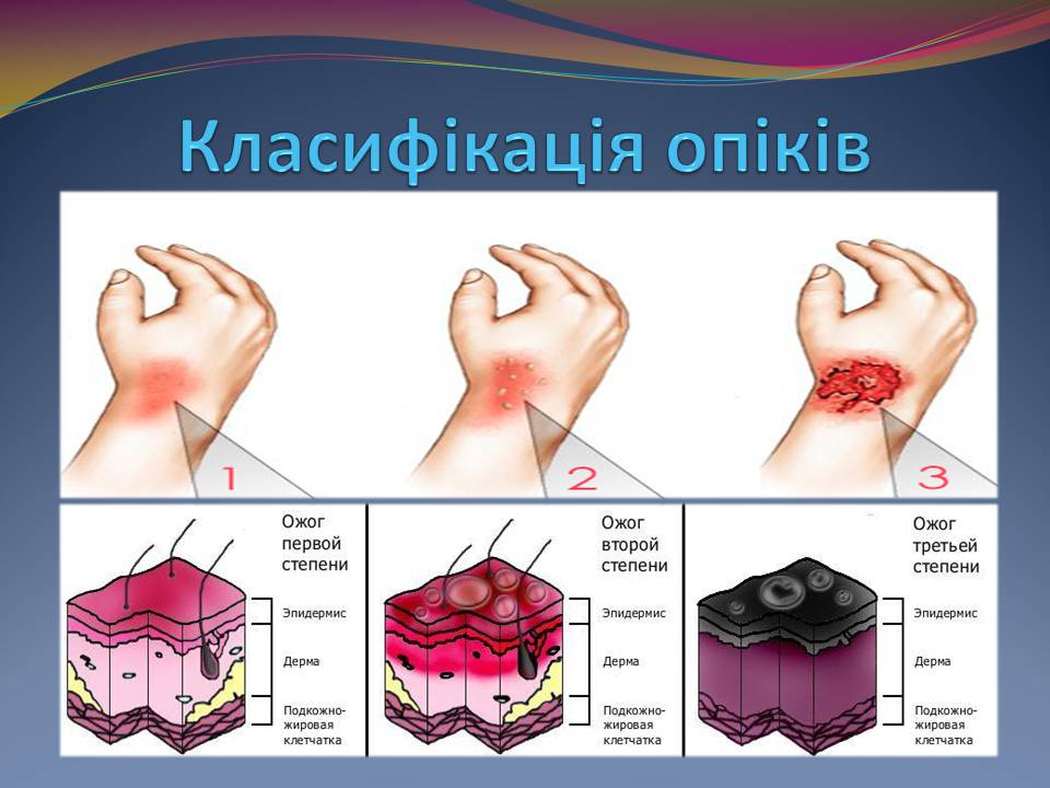 Презентація на тему «Опіки. Перша допомога при опіках» - Слайд #7 Презентація на тему «Опіки. Перша допомога при опіках» - Слайд #7