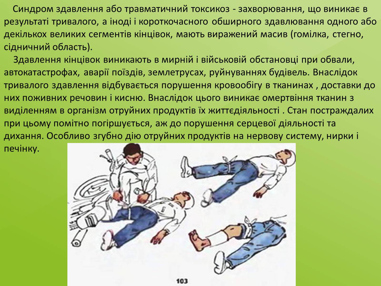 Презентація на тему «Тривале здавлювання» - Слайд #2 Презентація на тему «Тривале здавлювання» - Слайд #2