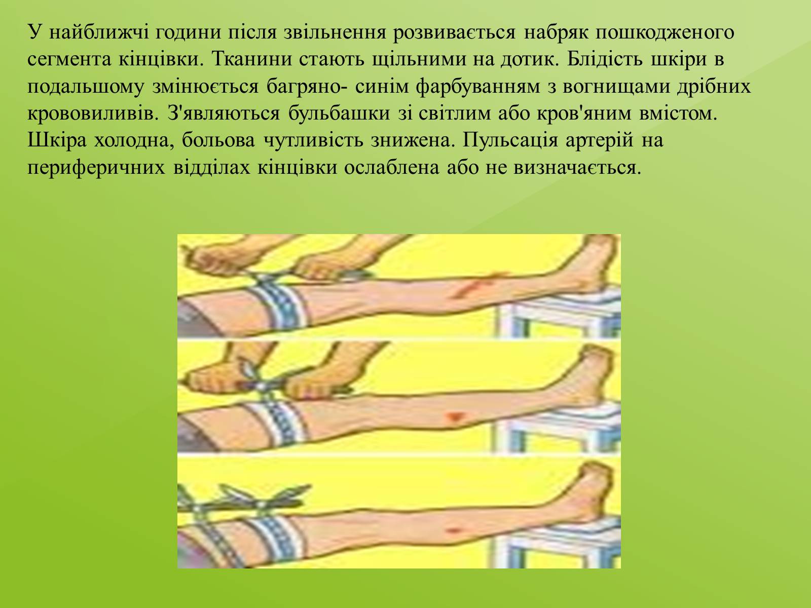 Презентація на тему «Тривале здавлювання» - Слайд #3 Презентація на тему «Тривале здавлювання» - Слайд #3