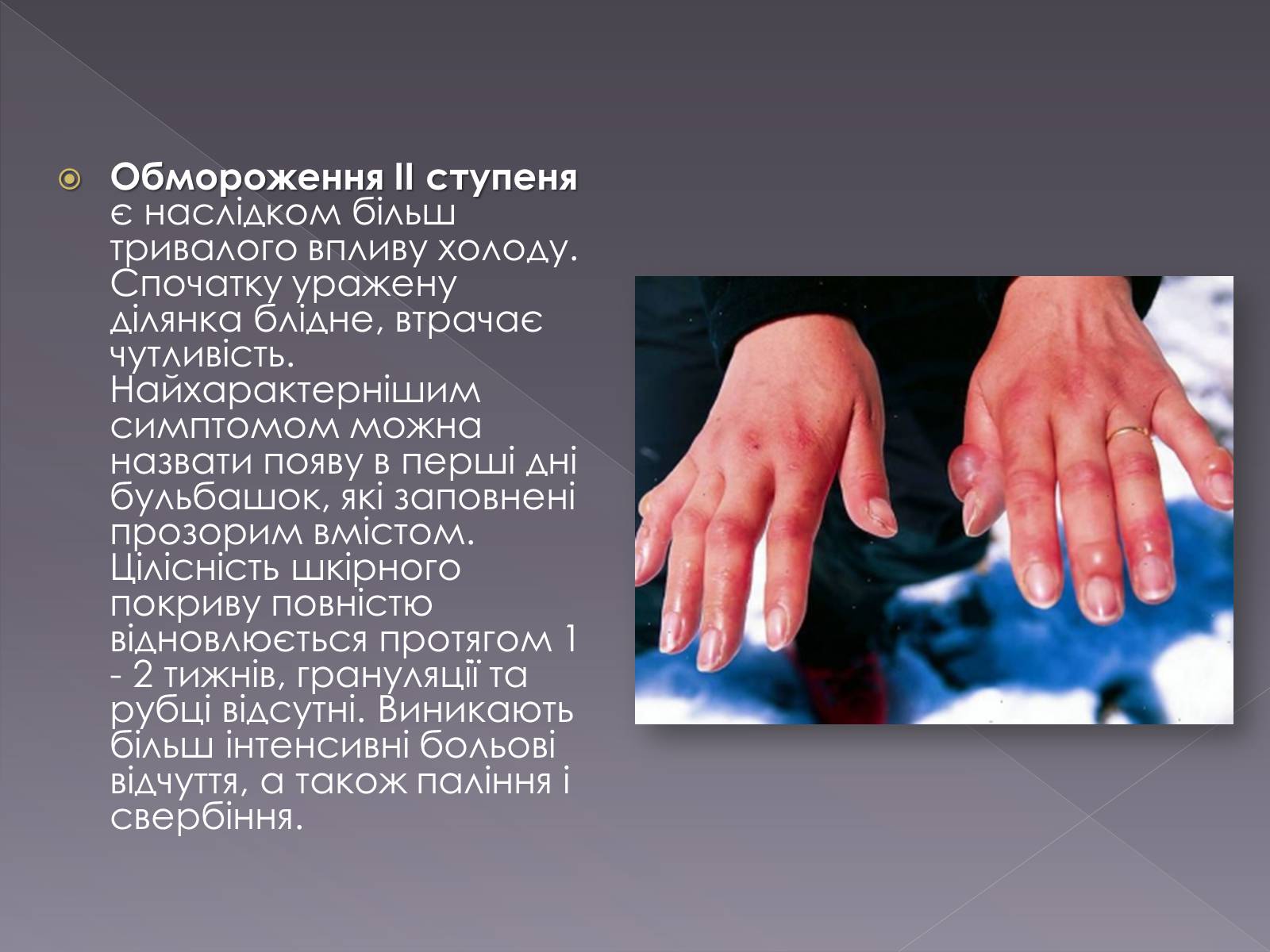 Презентація на тему «Небезпека обмороження» - Слайд #7 Презентація на тему «Небезпека обмороження» - Слайд #7