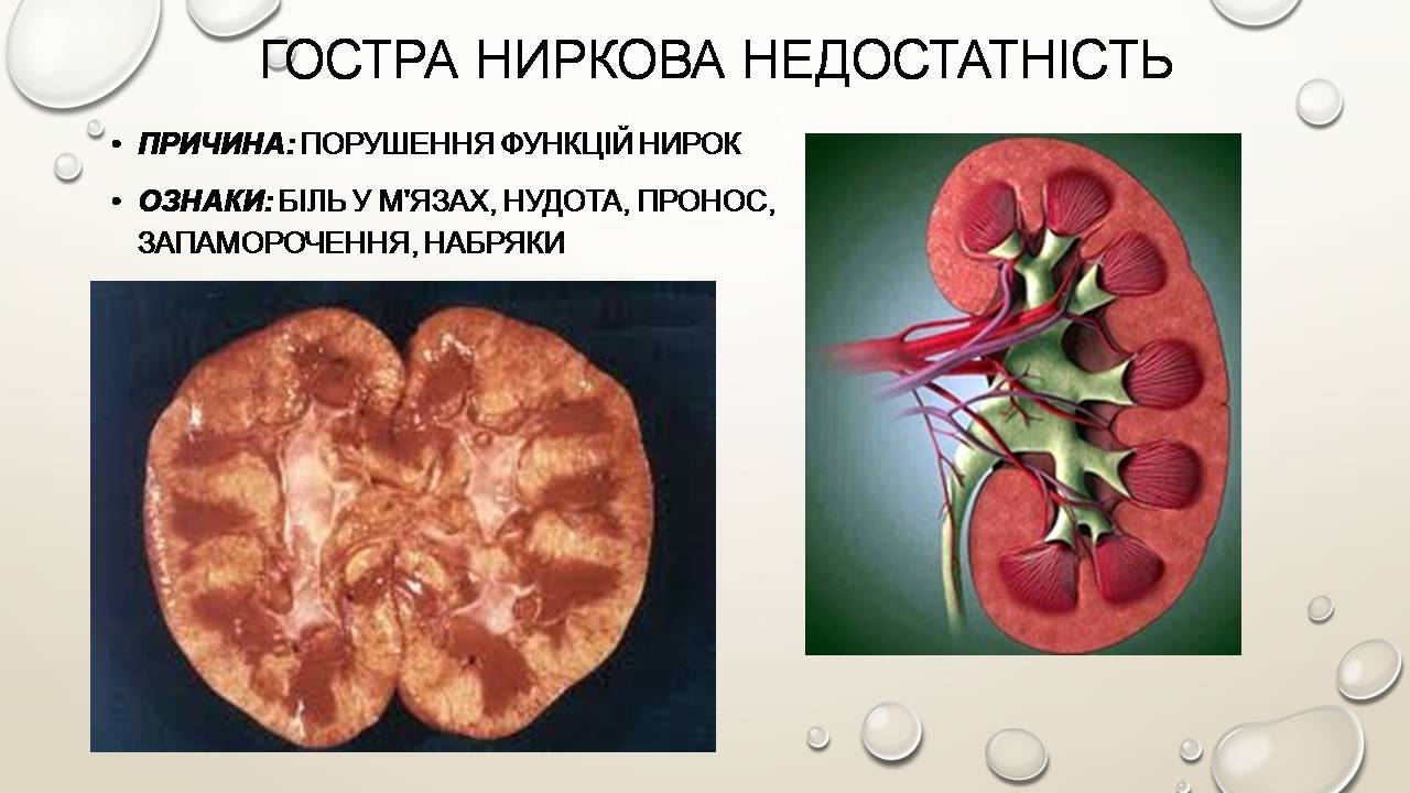 Презентація на тему «Перша допомога при захворюваннях шлунково-кишкового тракту та сечовивідної системи» - Слайд #11 Презентація на тему «Перша допомога при захворюваннях шлунково-кишкового тракту та сечовивідної системи» - Слайд #11