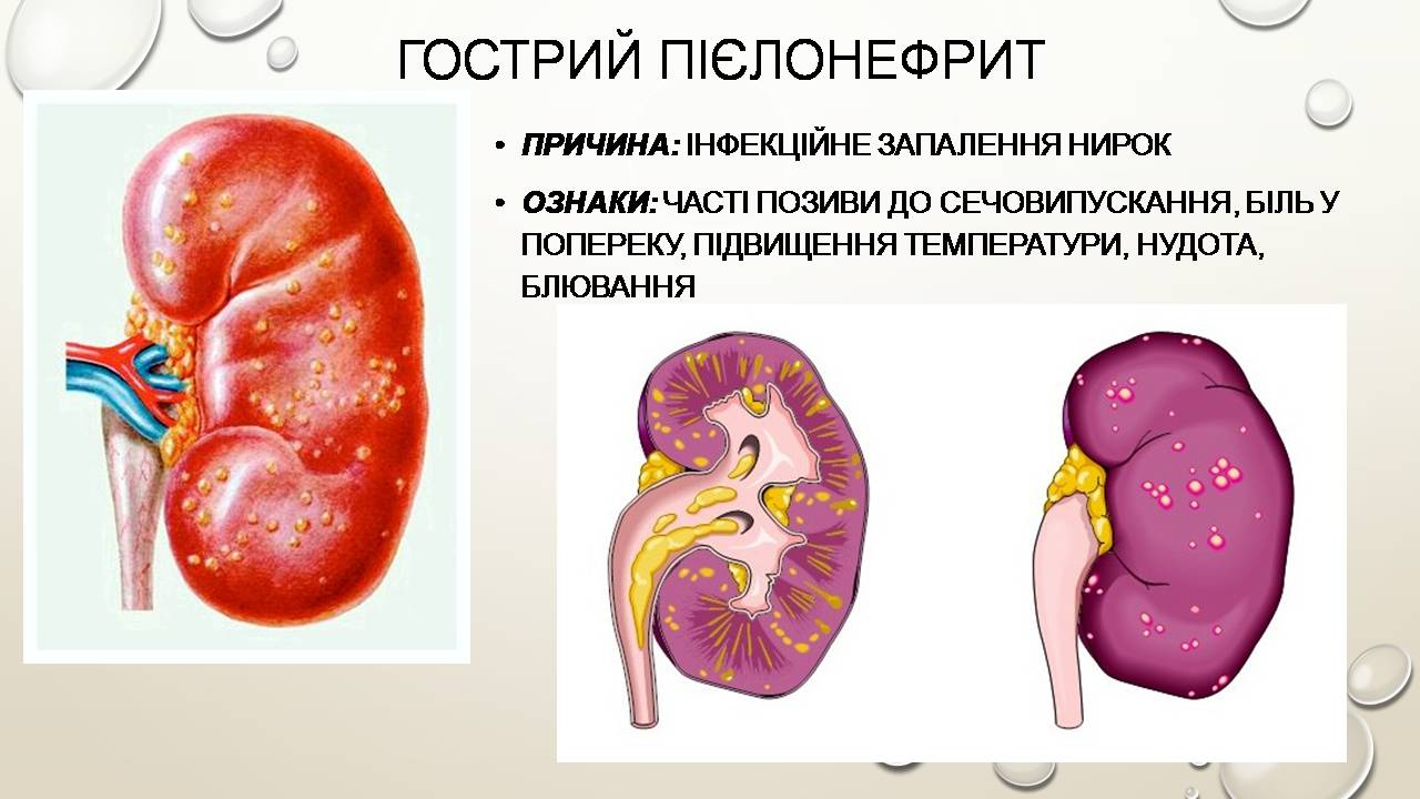 Презентація на тему «Перша допомога при захворюваннях шлунково-кишкового тракту та сечовивідної системи» - Слайд #12 Презентація на тему «Перша допомога при захворюваннях шлунково-кишкового тракту та сечовивідної системи» - Слайд #12