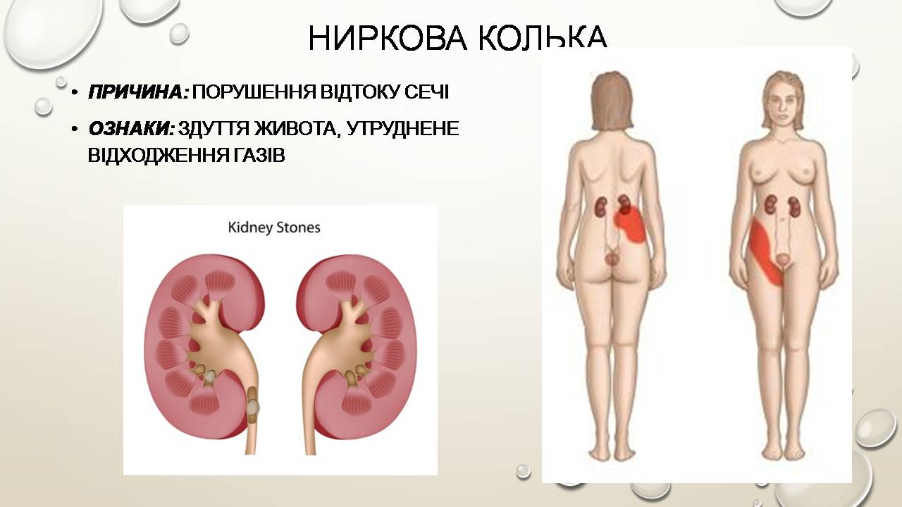 Презентація на тему «Перша допомога при захворюваннях шлунково-кишкового тракту та сечовивідної системи» - Слайд #14 Презентація на тему «Перша допомога при захворюваннях шлунково-кишкового тракту та сечовивідної системи» - Слайд #14