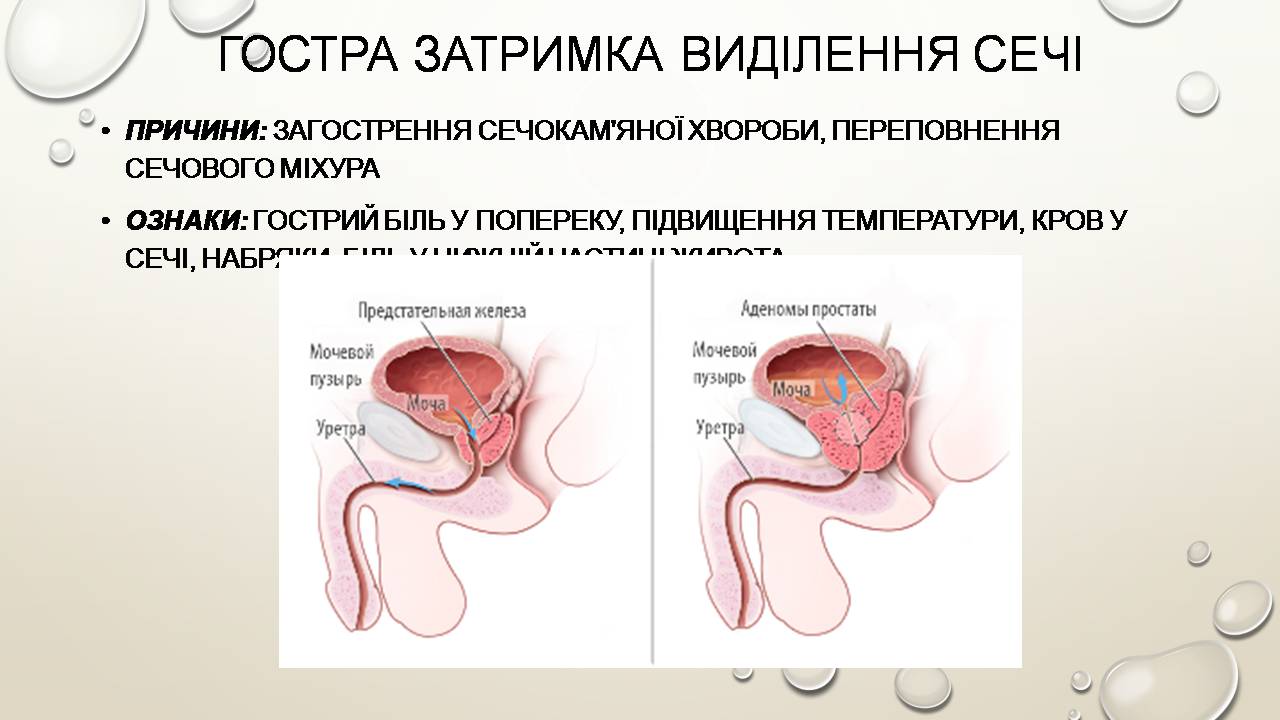 Презентація на тему «Перша допомога при захворюваннях шлунково-кишкового тракту та сечовивідної системи» - Слайд #15 Презентація на тему «Перша допомога при захворюваннях шлунково-кишкового тракту та сечовивідної системи» - Слайд #15