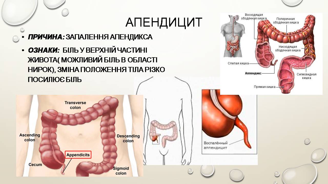 Презентація на тему «Перша допомога при захворюваннях шлунково-кишкового тракту та сечовивідної системи» - Слайд #4 Презентація на тему «Перша допомога при захворюваннях шлунково-кишкового тракту та сечовивідної системи» - Слайд #4