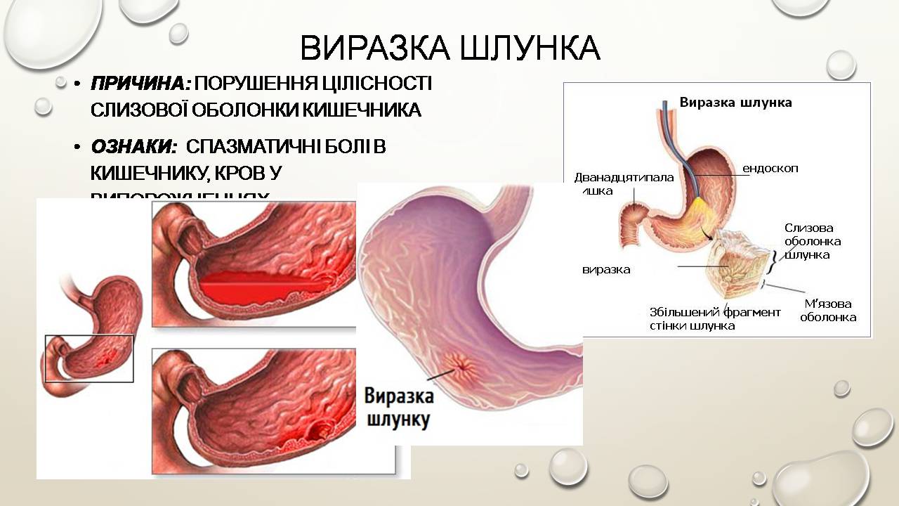 Презентація на тему «Перша допомога при захворюваннях шлунково-кишкового тракту та сечовивідної системи» - Слайд #5 Презентація на тему «Перша допомога при захворюваннях шлунково-кишкового тракту та сечовивідної системи» - Слайд #5