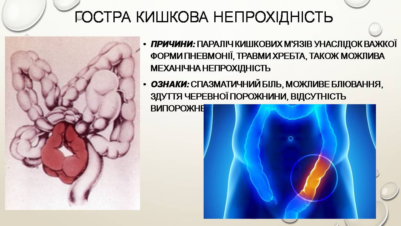 Презентація на тему «Перша допомога при захворюваннях шлунково-кишкового тракту та сечовивідної системи» - Слайд #6 Презентація на тему «Перша допомога при захворюваннях шлунково-кишкового тракту та сечовивідної системи» - Слайд #6