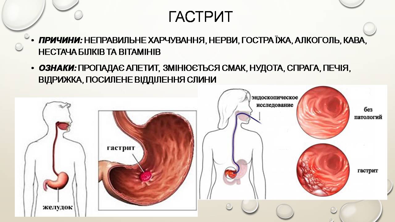 Презентація на тему «Перша допомога при захворюваннях шлунково-кишкового тракту та сечовивідної системи» - Слайд #7 Презентація на тему «Перша допомога при захворюваннях шлунково-кишкового тракту та сечовивідної системи» - Слайд #7
