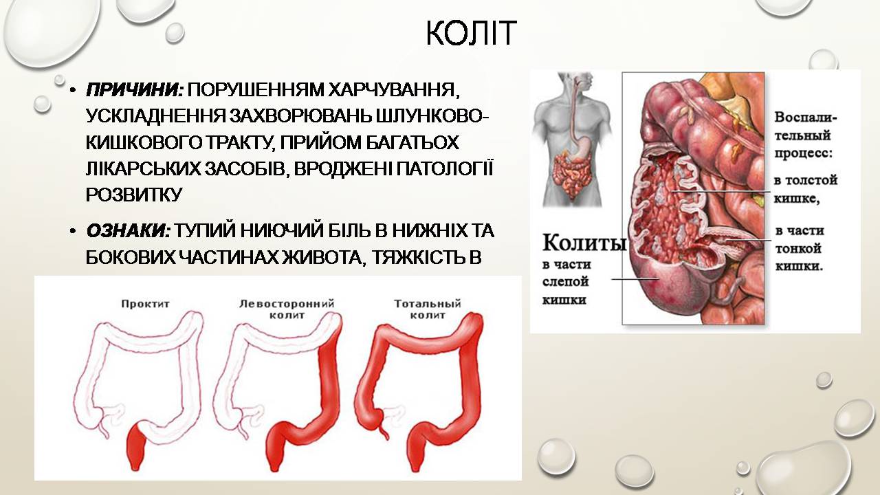 Презентація на тему «Перша допомога при захворюваннях шлунково-кишкового тракту та сечовивідної системи» - Слайд #8 Презентація на тему «Перша допомога при захворюваннях шлунково-кишкового тракту та сечовивідної системи» - Слайд #8