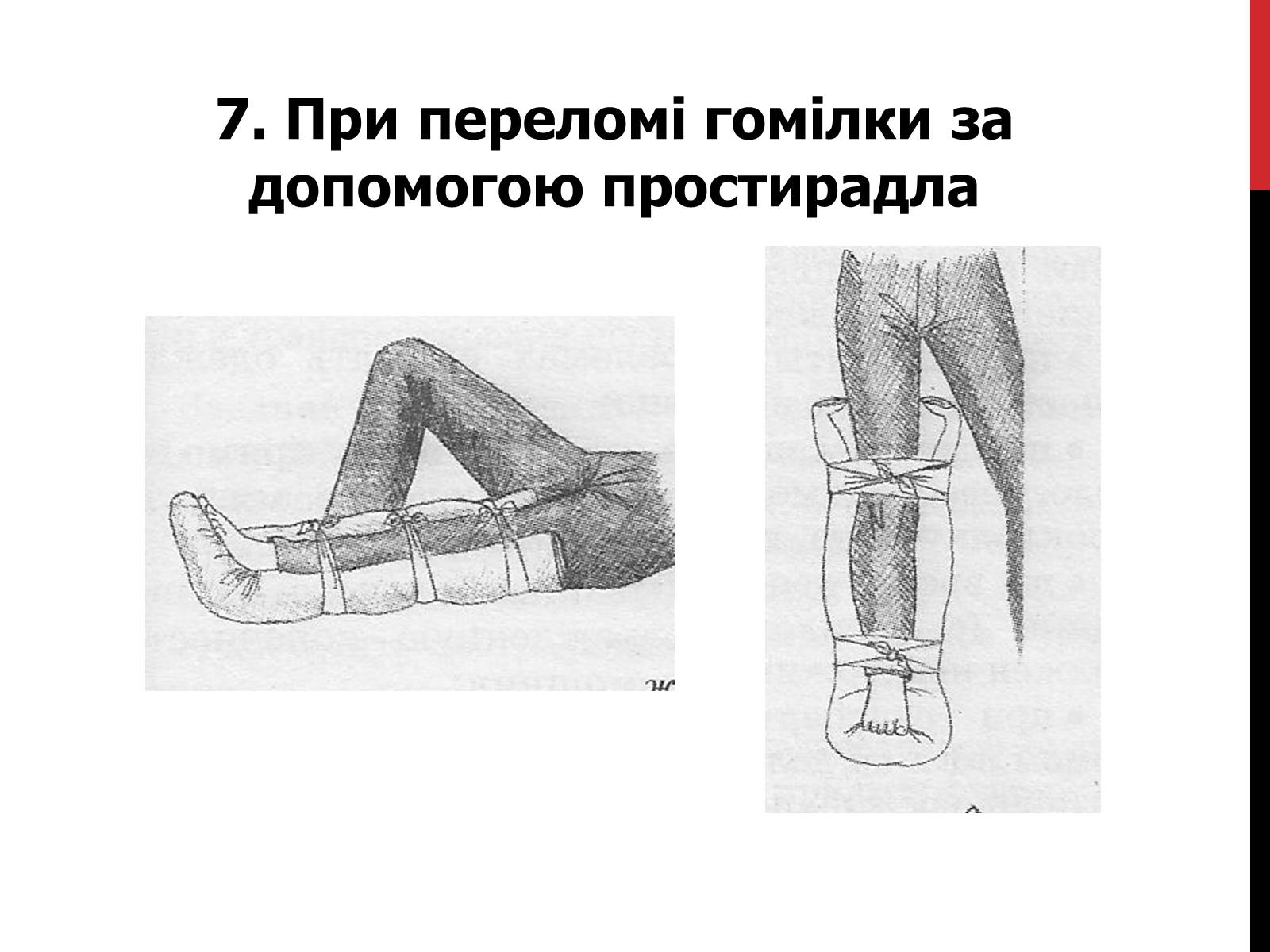 Презентація на тему «Іммобілізація верхніх та нижніх кінцівок» - Слайд #13 Презентація на тему «Іммобілізація верхніх та нижніх кінцівок» - Слайд #13