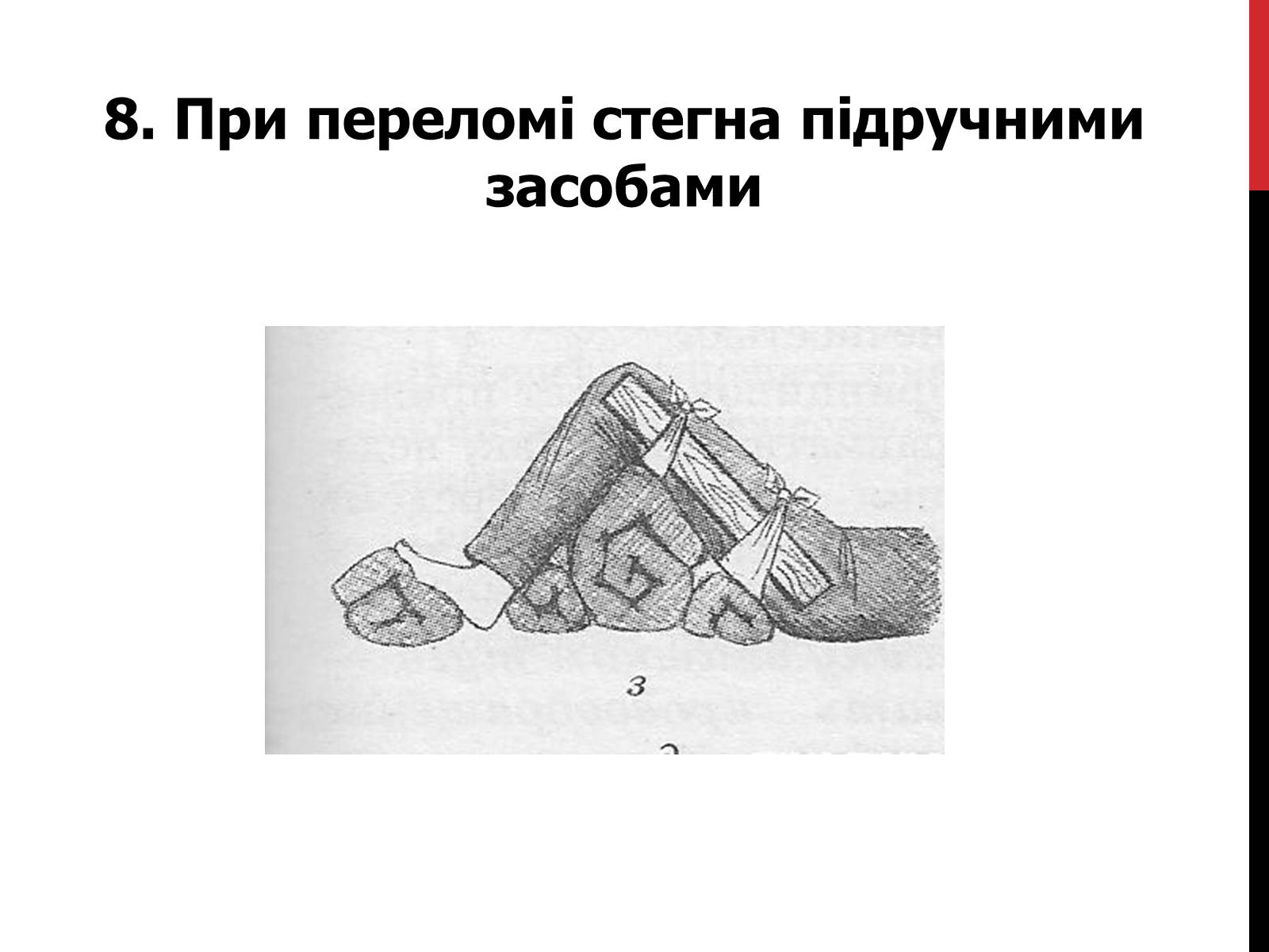 Презентація на тему «Іммобілізація верхніх та нижніх кінцівок» - Слайд #15 Презентація на тему «Іммобілізація верхніх та нижніх кінцівок» - Слайд #15