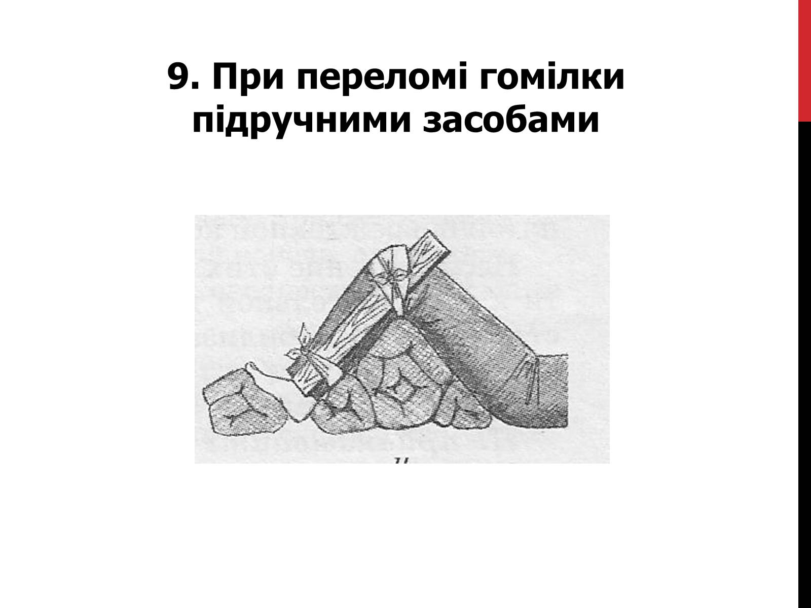Презентація на тему «Іммобілізація верхніх та нижніх кінцівок» - Слайд #16 Презентація на тему «Іммобілізація верхніх та нижніх кінцівок» - Слайд #16